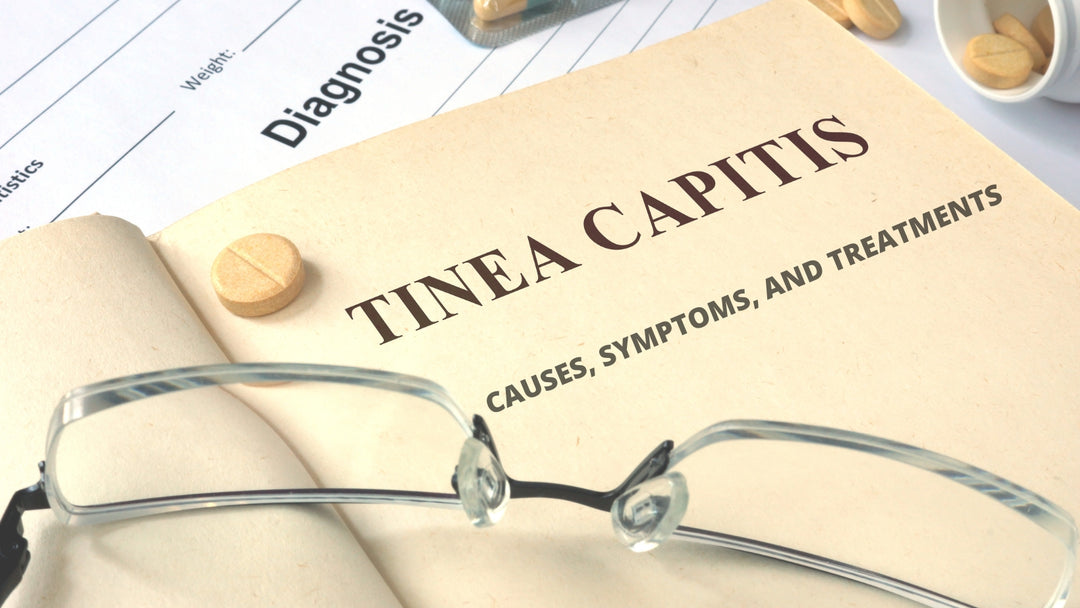 TINEA CAPITIS