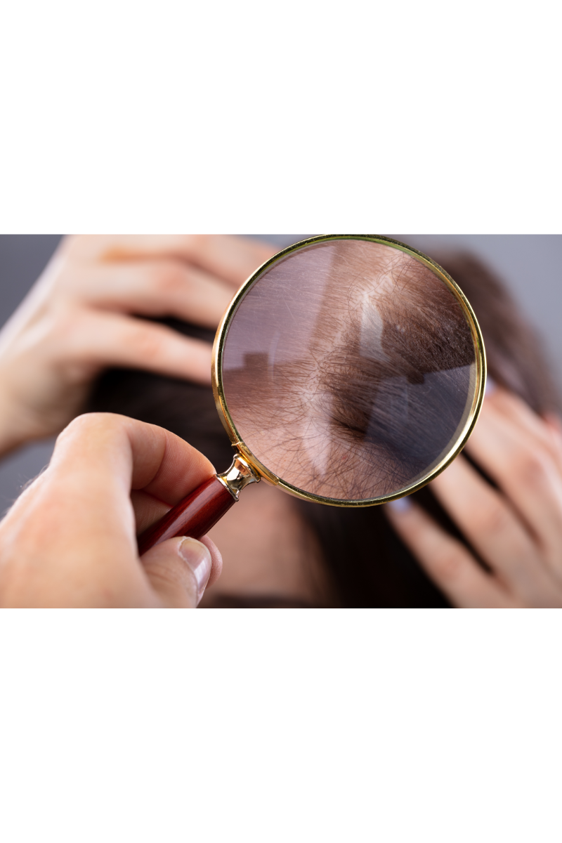 This image shows a hairball resulting from medical hair loss, emphasizing the need for wigs as a solution to help women regain confidence and self-esteem. Our website offers a wide selection of high-quality wigs for women suffering from hair loss.